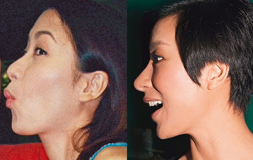 Plastic Surgery: Tavia Yeung’s Growing “Pinnochio” Nose thumbnail